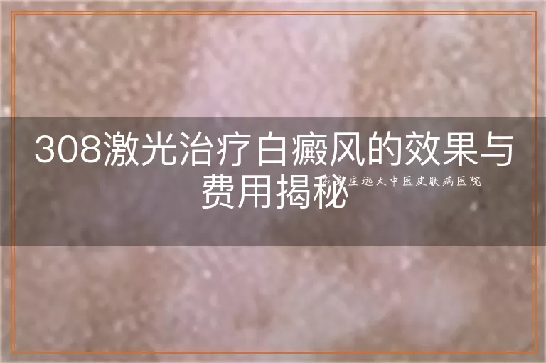 308激光治疗白癜风的效果与费用揭秘