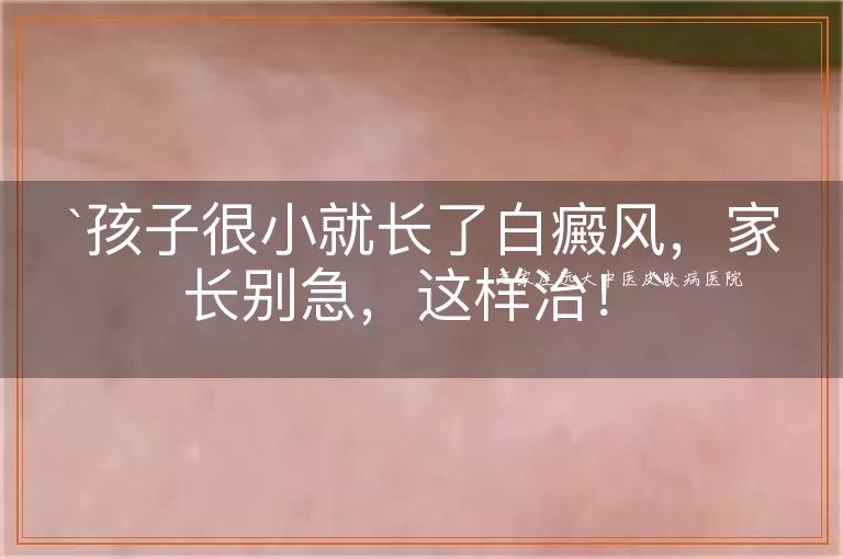 孩子很小就长了白癜风，家长别急，这样治！