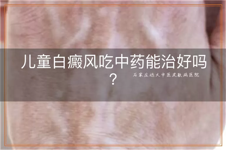 儿童白癜风吃中药能治好吗？