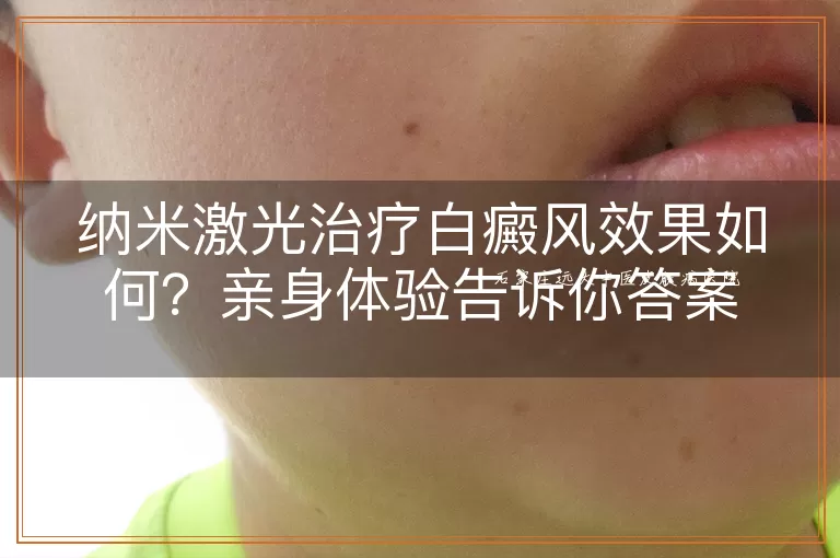 纳米激光治疗白癜风效果如何？亲身体验告诉你答案