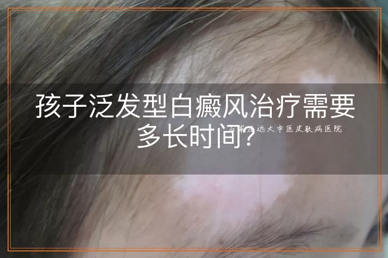 孩子泛发型白癜风治疗需要多长时间？