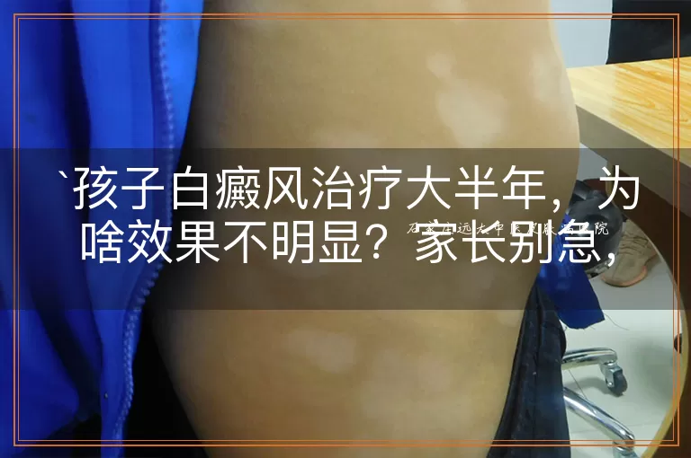 孩子白癜风治疗大半年，为啥效果不明显？家长别急，咱一起找找原因