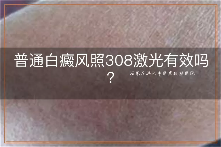 普通白癜风照308激光有效吗？
