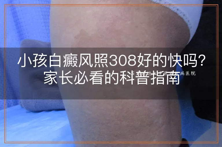 小孩白癜风照308好的快吗？家长必看的科普指南