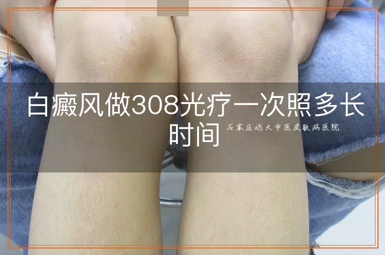 白癜风做308光疗一次照多长时间