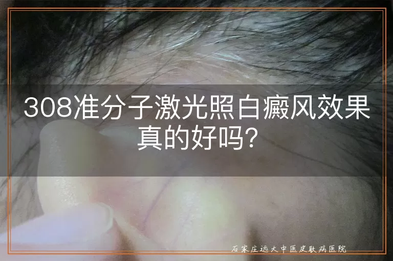 308准分子激光照白癜风效果真的好吗？