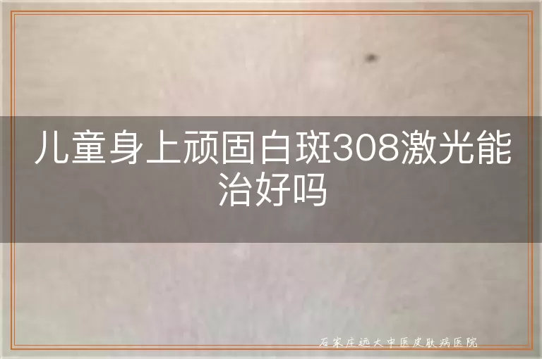 儿童身上顽固白斑308激光能治好吗