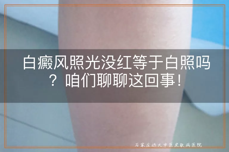 白癜风照光没红等于白照吗？咱们聊聊这回事！