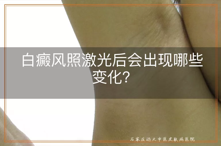 白癜风照激光后会出现哪些变化?