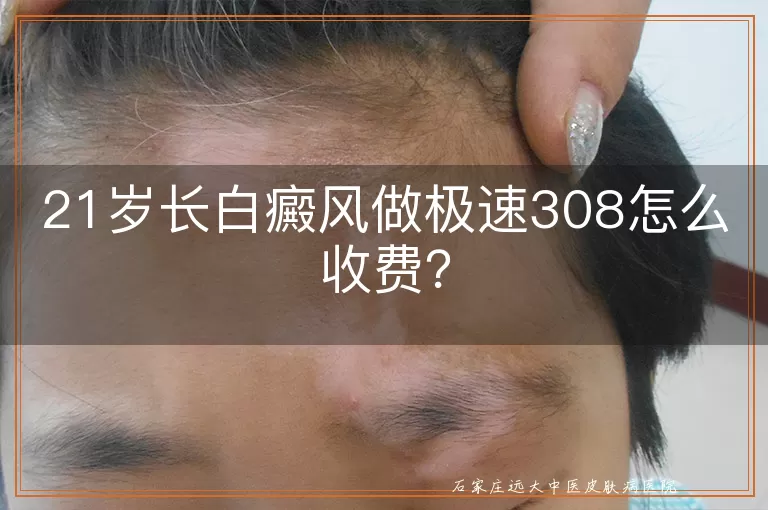 21岁长白癜风做极速308怎么收费？