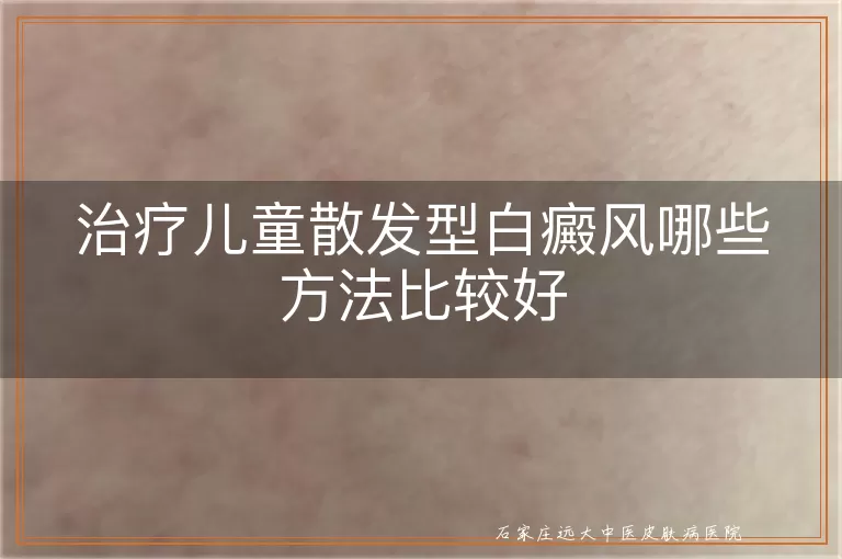 治疗儿童散发型白癜风哪些方法比较好