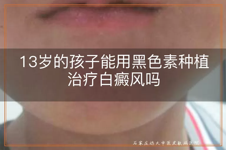 13岁的孩子能用黑色素种植治疗白癜风吗