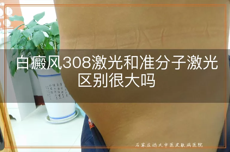 白癜风308激光和准分子激光区别很大吗