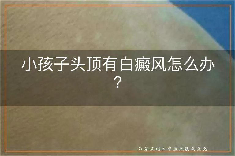 小孩子头顶有白癜风怎么办？