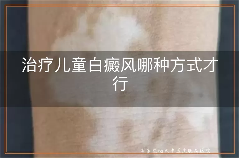 治疗儿童白癜风哪种方式才行