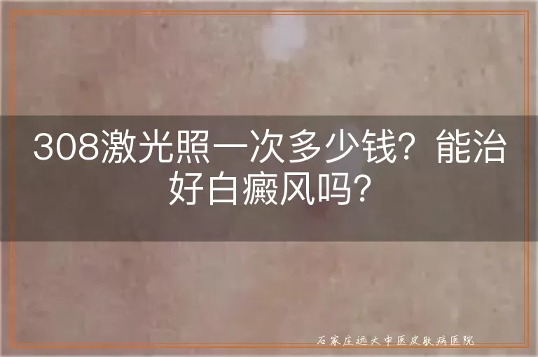 308激光照一次多少钱？能治好白癜风吗？