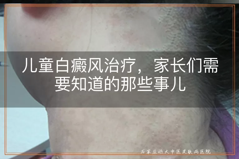 儿童白癜风治疗，家长们需要知道的那些事儿