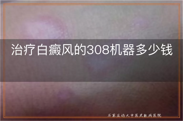 治疗白癜风的308机器多少钱
