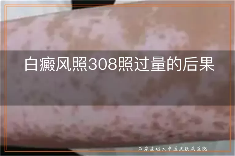 白癜风照308照过量的后果