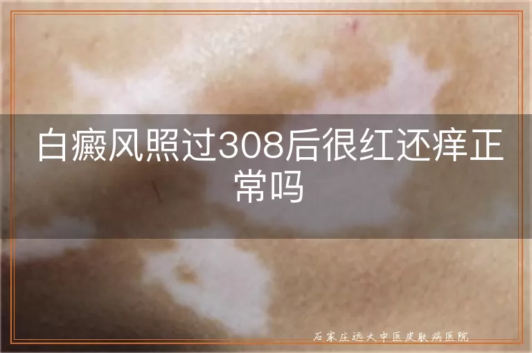 白癜风照过308后很红还痒正常吗