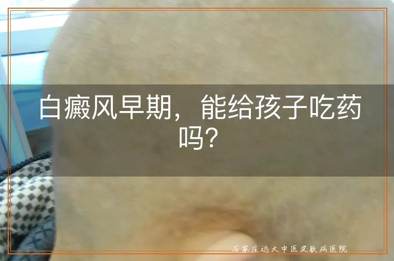 白癜风早期，能给孩子吃药吗？