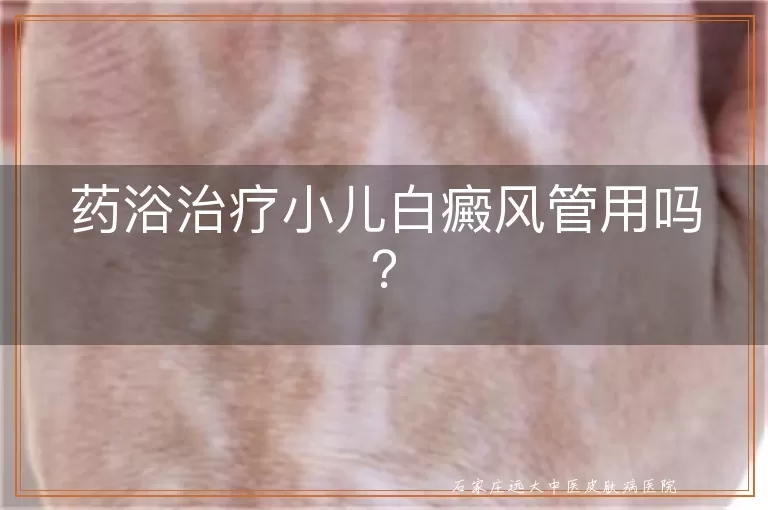 药浴治疗小儿白癜风管用吗？