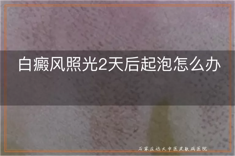 白癜风照光2天后起泡怎么办