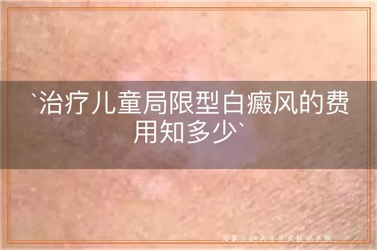 治疗儿童局限型白癜风的费用知多少