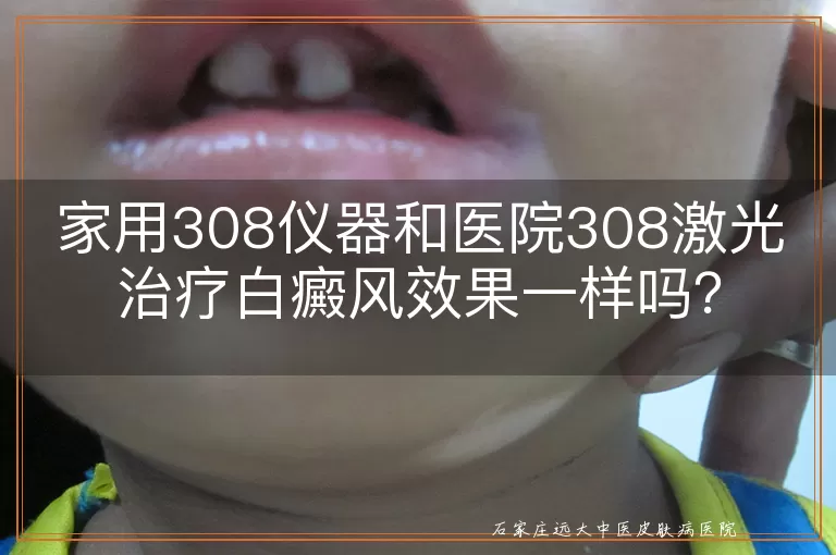 家用308仪器和医院308激光治疗白癜风效果一样吗？