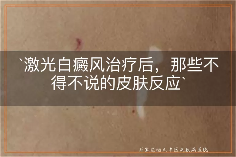 激光白癜风治疗后，那些不得不说的皮肤反应