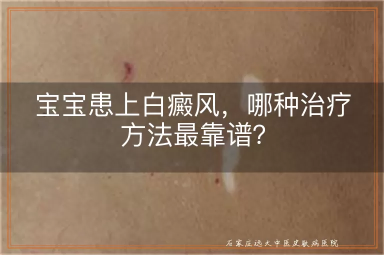 宝宝患上白癜风，哪种治疗方法最靠谱？