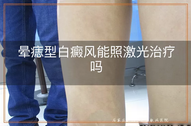 晕痣型白癜风能照激光治疗吗