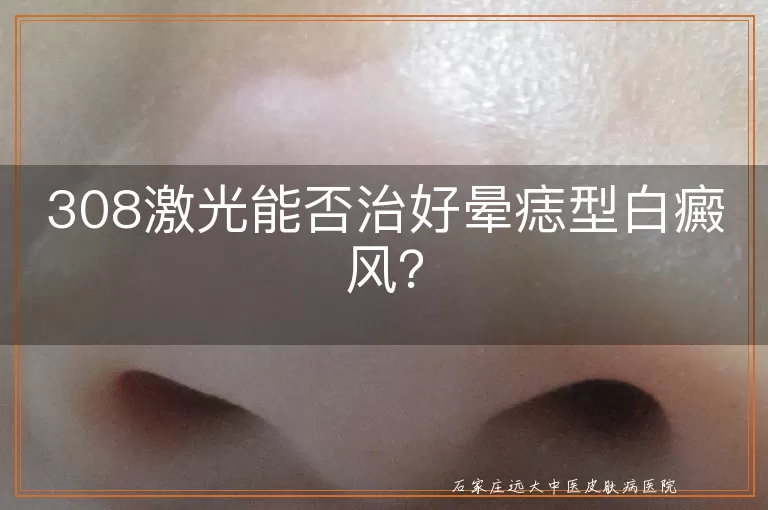 308激光能否治好晕痣型白癜风？