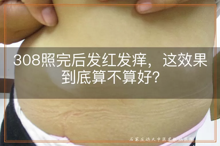 308照完后发红发痒，这效果到底算不算好？