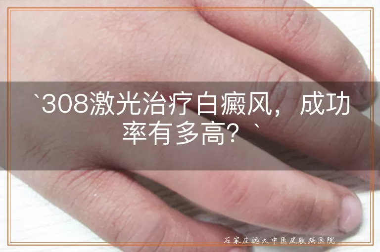 308激光治疗白癜风，成功率有多高？