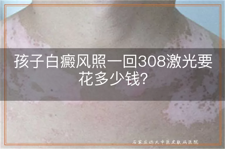 孩子白癜风照一回308激光要花多少钱？