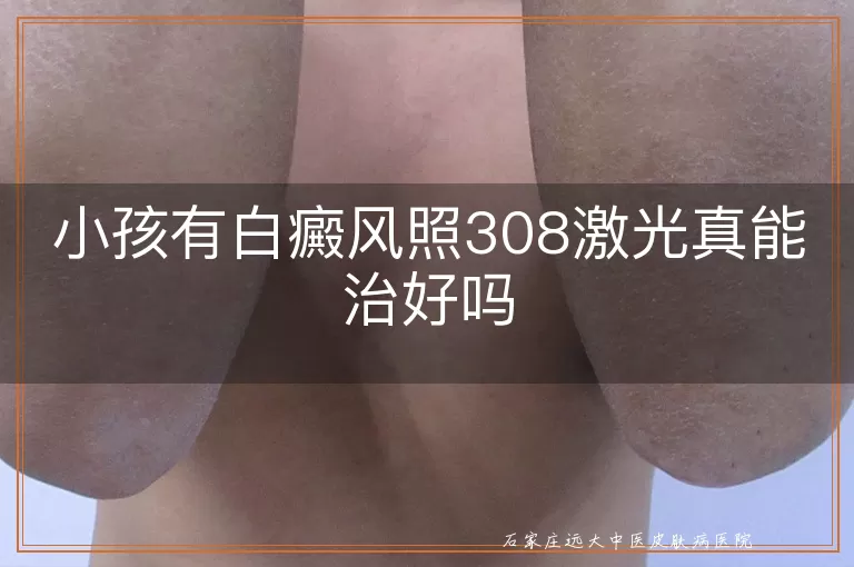 小孩有白癜风照308激光真能治好吗
