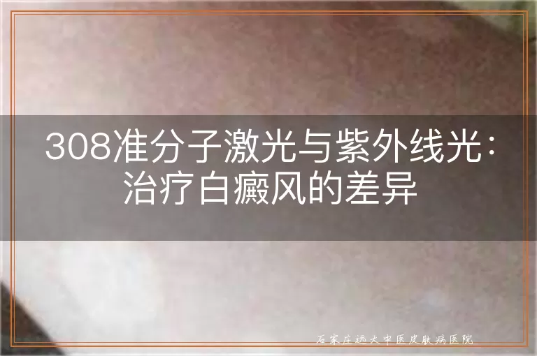 308准分子激光与紫外线光：治疗白癜风的差异