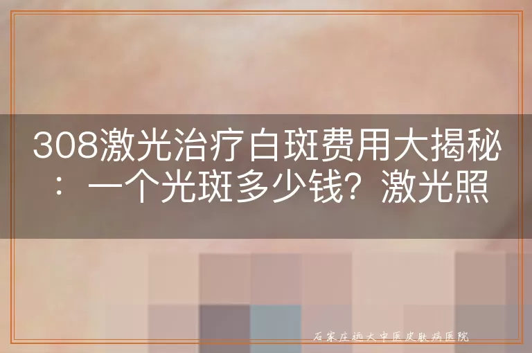 308激光治疗白斑费用大揭秘：一个光斑多少钱？激光照白斑怎么收费？