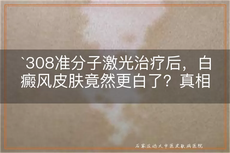 308准分子激光治疗后，白癜风皮肤竟然更白了？真相揭秘！
