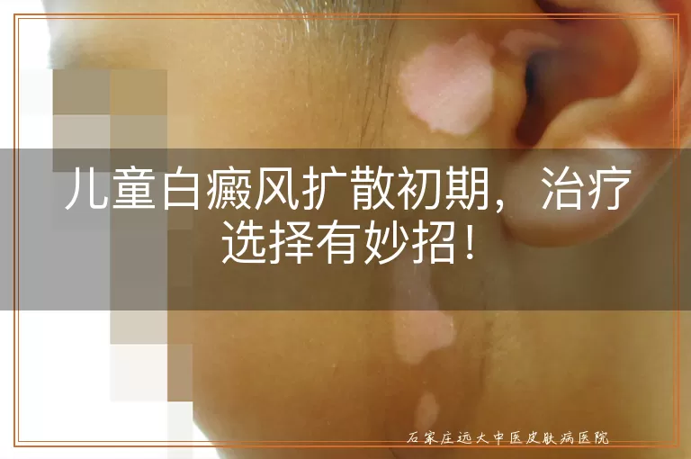 儿童白癜风扩散初期，治疗选择有妙招！