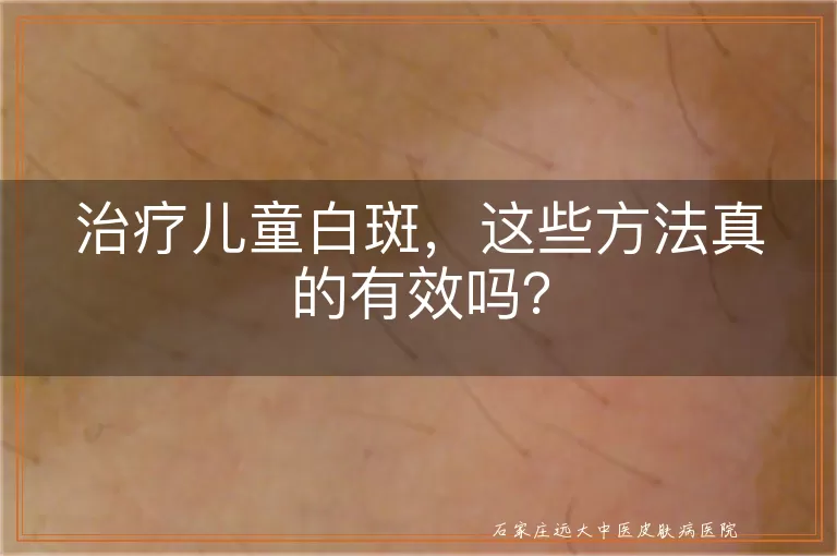 治疗儿童白斑，这些方法真的有效吗？