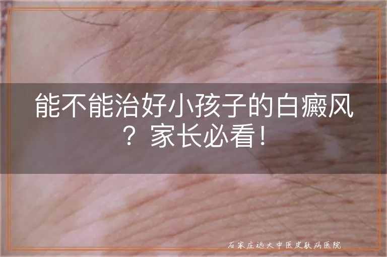 能不能治好小孩子的白癜风？家长必看！