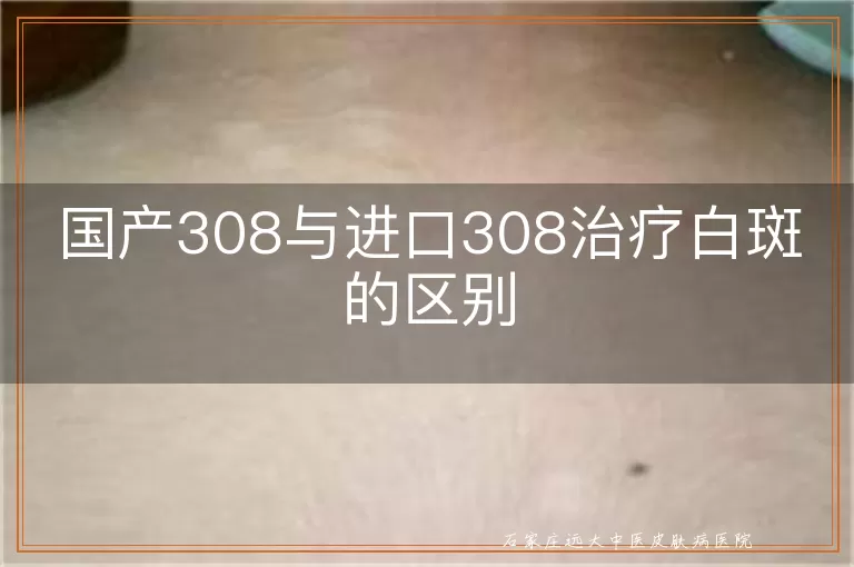 国产308与进口308治疗白斑的区别