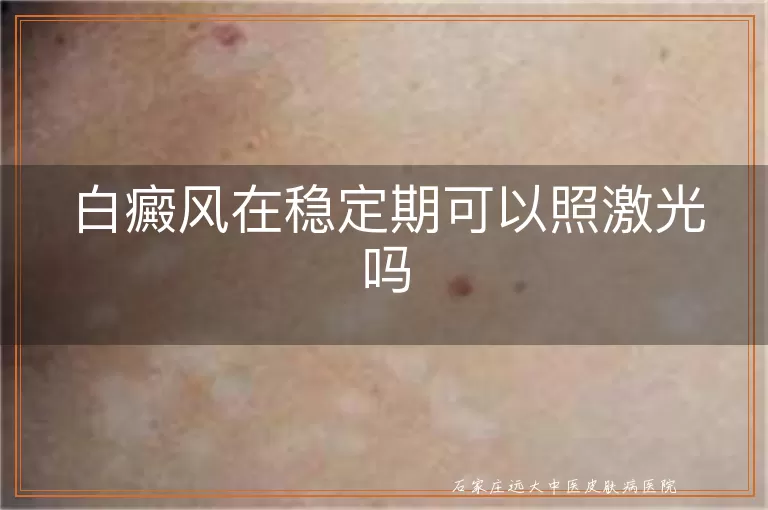 白癜风在稳定期可以照激光吗