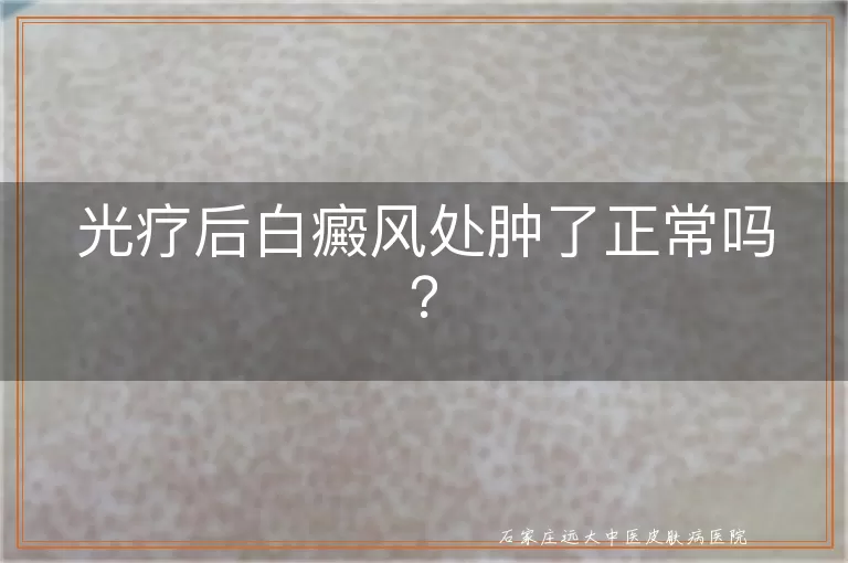 光疗后白癜风处肿了正常吗？