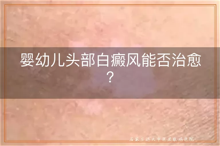 婴幼儿头部白癜风能否治愈？