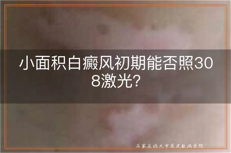 小面积白癜风初期能否照308激光？