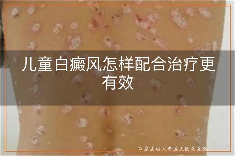 儿童白癜风怎样配合治疗更有效