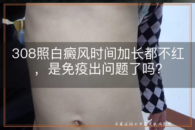 308照白癜风时间加长都不红，是免疫出问题了吗？